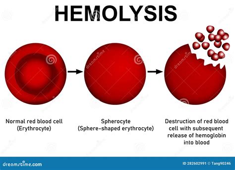 Hemolysis: What’s Normal, Abnormal, and Maybe .